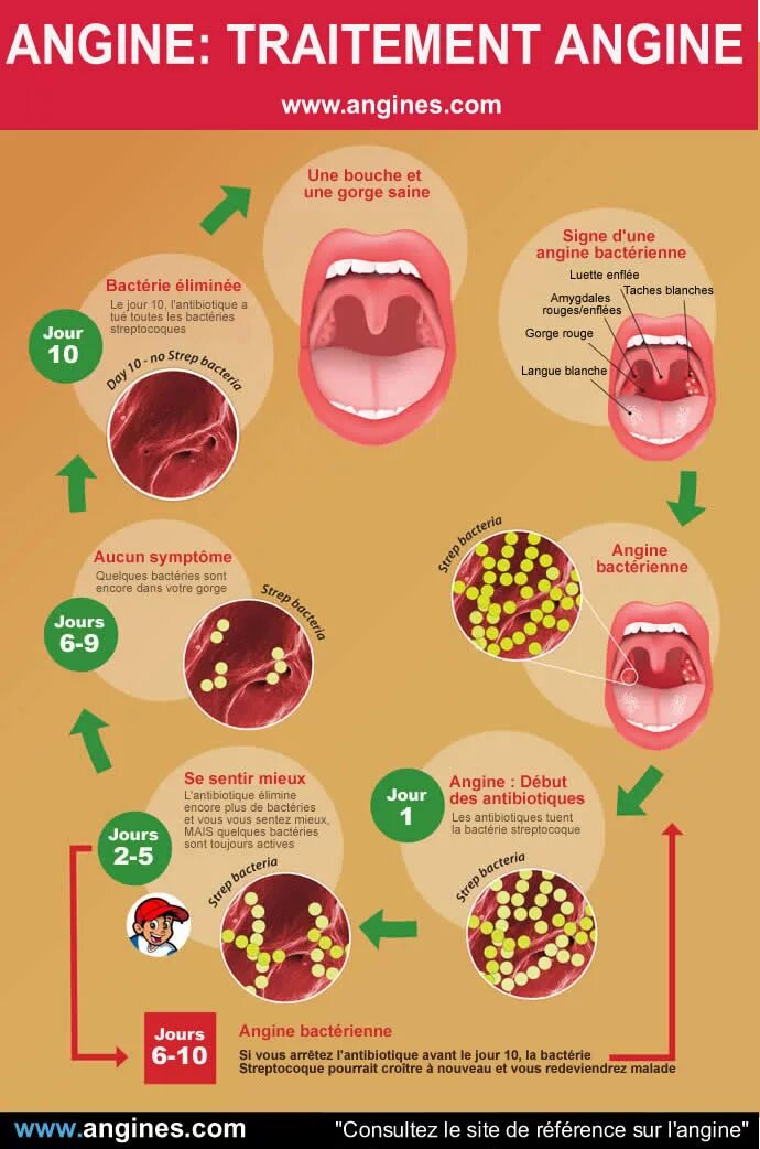 Лечение ангины гнойной у взрослых эффективные