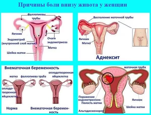 Почему тянет живот во время месячных. Болит низ живота перед месячными. болит низ живота при месячных. месячные болит низ живота. боли при месячных.