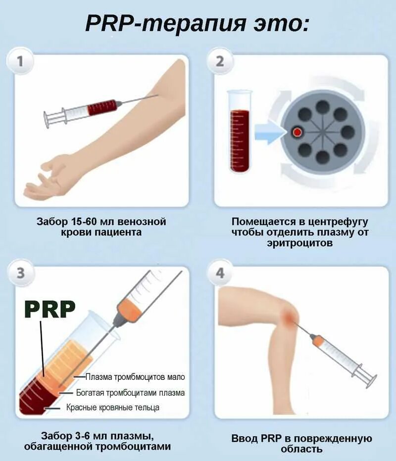 PRP терапия Platelet Rich Plasma. PRP-терапию (плазма обогащенная тромбоцитами). Плазмотерапия суставов (PRP-терапия, плазмолифтинг). Плазма крови в лицо