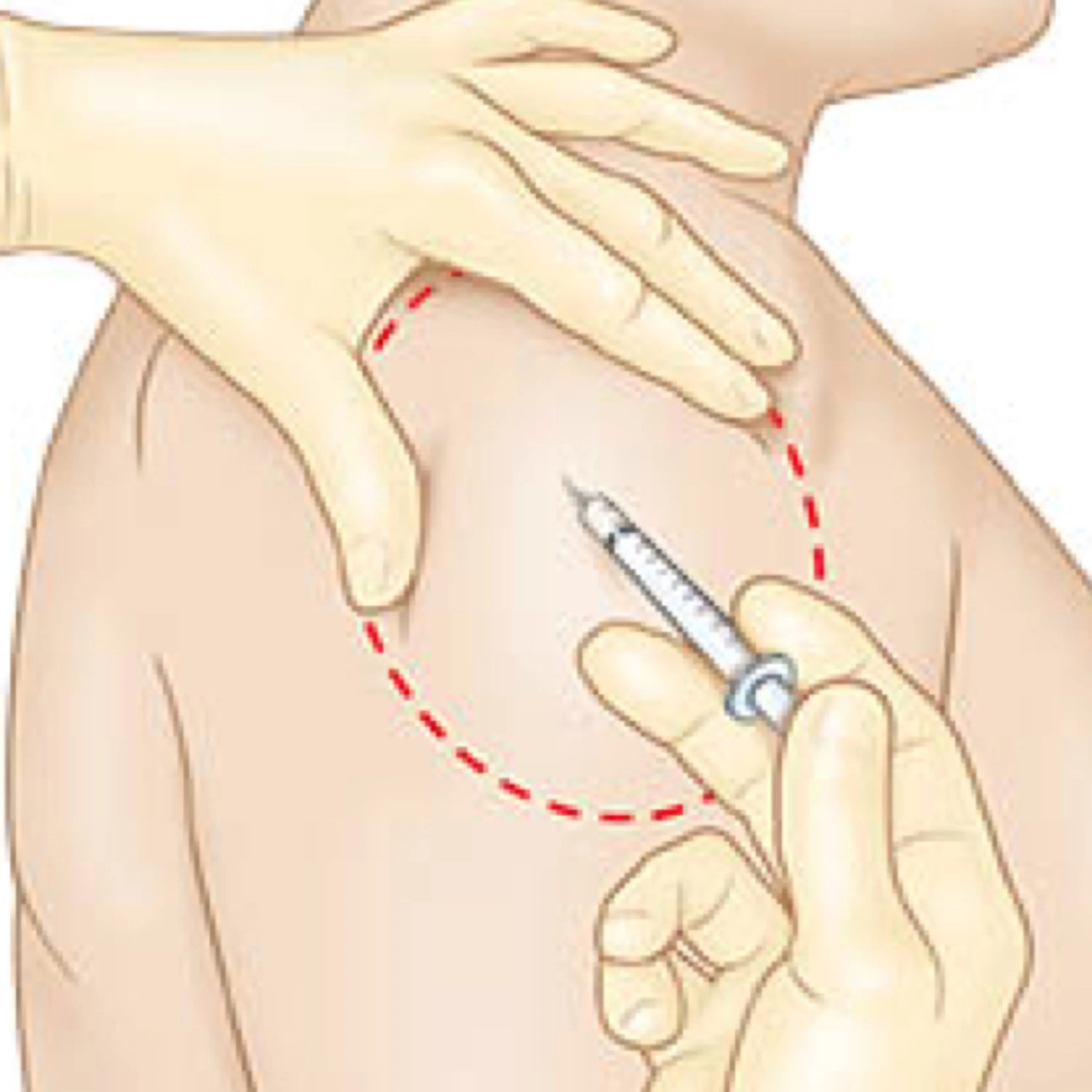 Как ставить инъекции. Укол подкожно в плечо. Внутримышечная инъекция. Укол в руку внутримышечно.