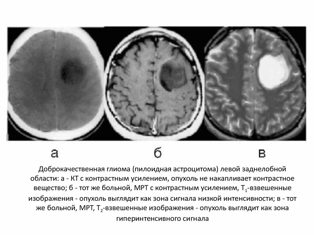Доброкачественные опухоли головного мозга кт. Доброкачественная астроцитома мрт. Опухоль головного глиома кт. Глиома головного мозга кт.