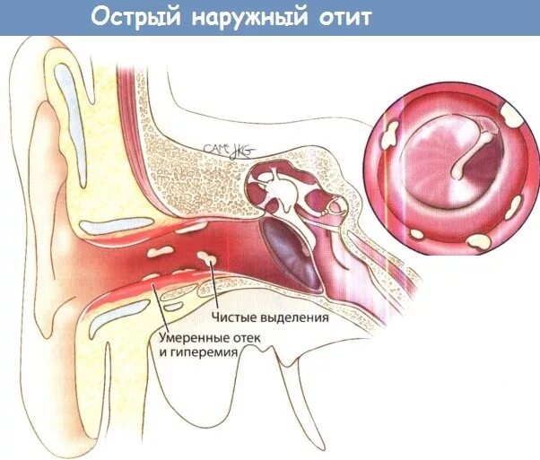 Воспаление среднего уха. Острый левосторонний наружный отит. При глотании слюны в ухе