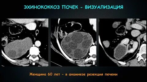 Диагностика эхинококкоза печени