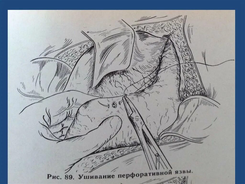 Прободная язва боли. Перфоративная язва желудка и 12-перстной кишки. Ушивание язвы желудка лапароскопически. Ушивание перфоративной. Ушивание перфорации ДПК.