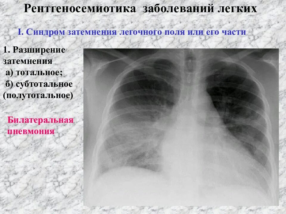 Затемнение верхней доли легкого. Тотальное и субтотальное затемнение легочного поля. Субтотальное затемнение легких. Субтотальная пневмония рентген. Синдром субтотального затемнения легочного поля.