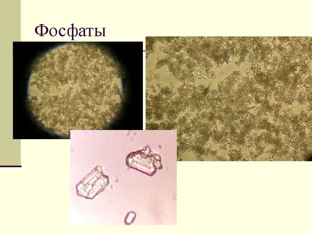 Фосфаты в какой моче. Ураты микроскопия. Аморфные Ураты микроскопия мочи. Аморфные фосфаты в моче микроскопия. Ураты и фосфаты в моче микроскопия.