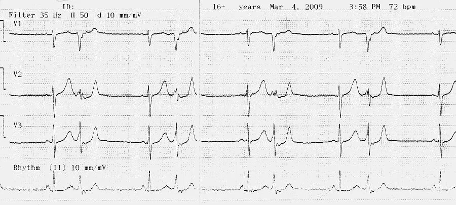 Аберрантные экстрасистолы на ЭКГ. Наджелудочковая экстрасистолия бигеминия ЭКГ. Бигеминия на ЭКГ. Предсердные экстрасистолы на ЭКГ. Аберрантные экстрасистолы