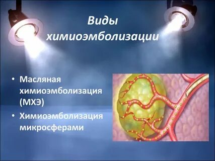 Химиоэмболизация печени отзывы
