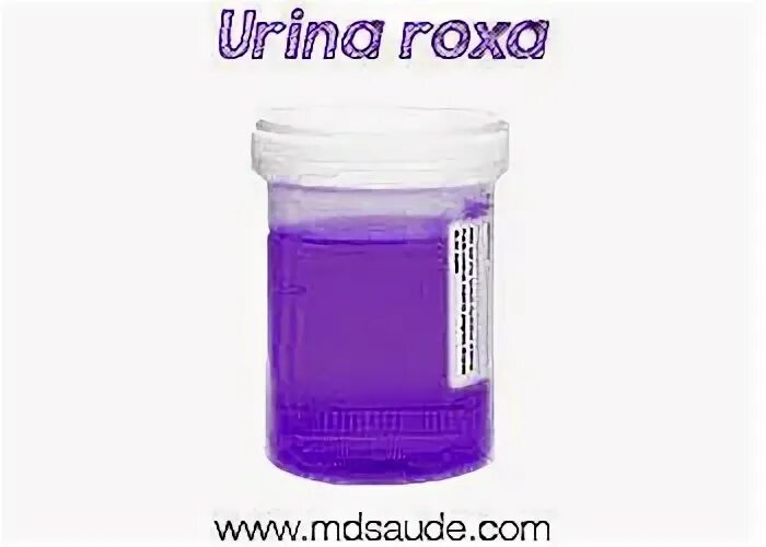 Фиолетовая моча