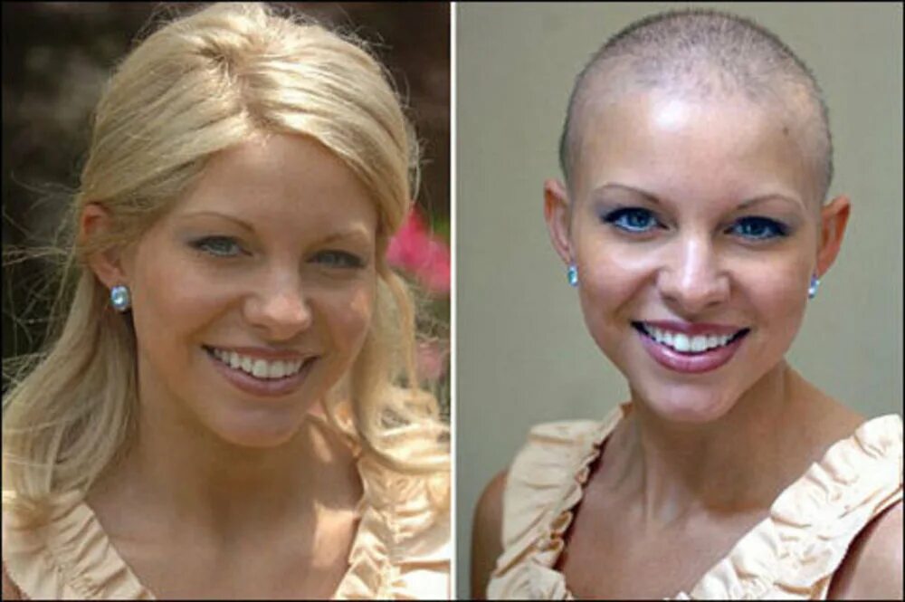 Какие волосы после химиотерапии. Волосы после химиотерапии. Лысые девушки до и после. Лысые причёски для женщин. Прическа после химиотерапии.