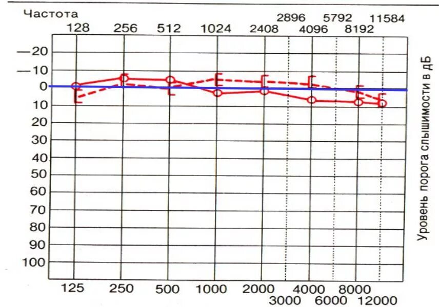 Аудиограмма слуха норма график. Аудиограмма здорового человека норма. Расшифровка аудиограммы слуха норма. Аудиометрия норма график. Аудиограмма норма