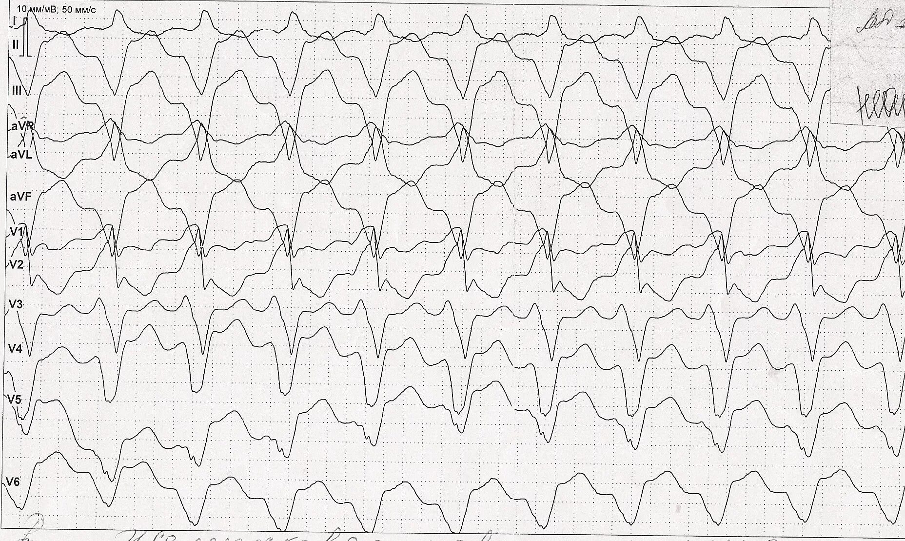 Желудочковая тахикардия на экг. Пароксизмальная тахикардия желудочков ЭКГ. Пароксизмальная желудочковая тахикардия. Правожелудочковая пароксизмальная тахикардия. Пароксизмальная желудочковая тахикардия на ЭКГ.