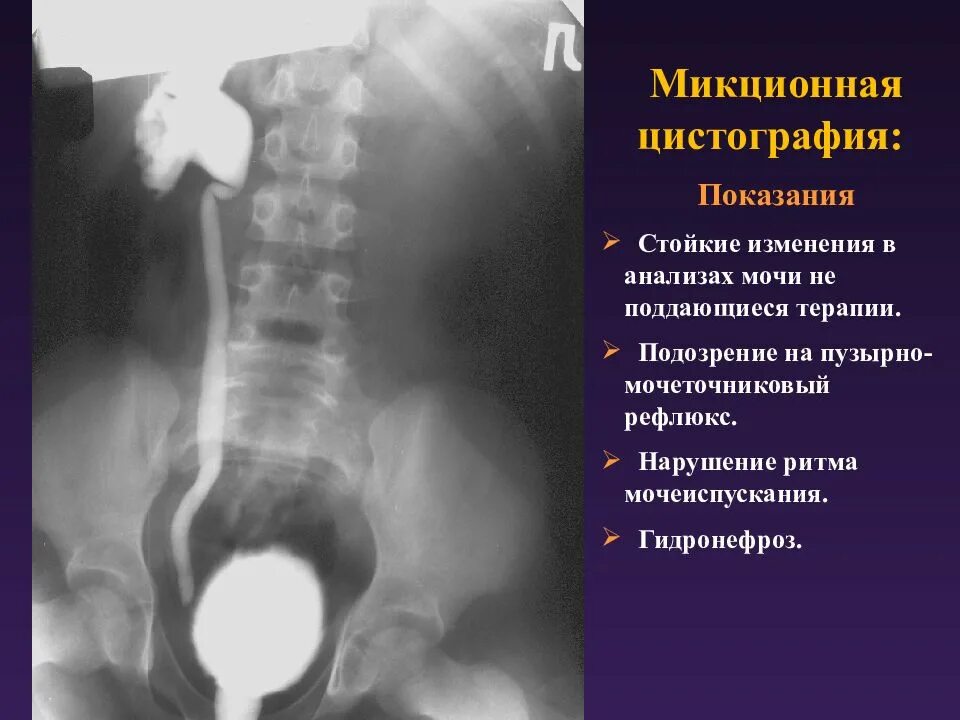 Пузырно мочеточниковый рефлюкс снимок. Микционная цистография мочевого пузыря. Пузырно-мочеточниковый рефлюкс цистоуретрография. Пузырно-мочеточниковый рефлюкс степени рентген. Рефлюкс мочеточника