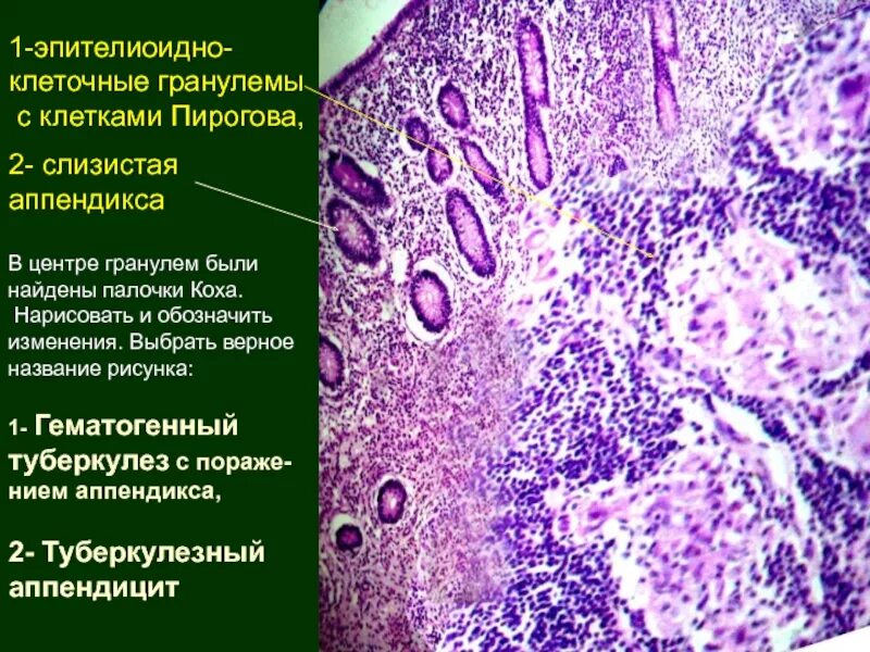 Сифилитическая гранулема микроскопия. Эпителиоидные клетки гистология. Клеточная гранулема. Клетки вирхова микропрепарат. Телеангиэктатическая гранулема.