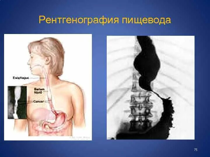 Пищевода с барием. Рентгенологическое исследование пищевода. Рентгенограмма пищевода. Рентгенография пищевода и желудка. Рентгеноскопия желудка и пищевода.