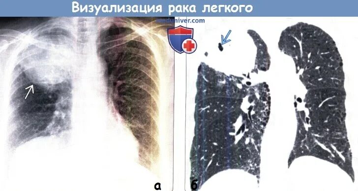 Черные точки на легких. Пятно на легких при кт. Объемное образование легкого на кт. Черное пятно на кт легких. Черное пятно на рентгене легких.