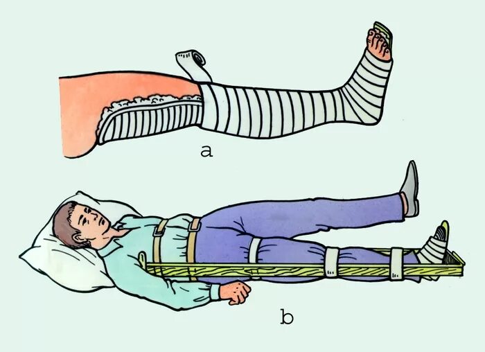 Перелом голени транспортировка. Иммобилизация при переломе голени шиной Крамера. Иммобилизация при переломе шейки бедра шиной Крамера. Перелом бедра транспортная иммобилизация. Шина Крамера перелом костей голени.