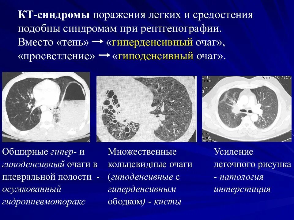 Синдромы поражения легких. Гиперденсивный очаг в печени кт. Гиперденсивный очаг на кт. Поражение легких на кт. Очаговое поражение легких кт.