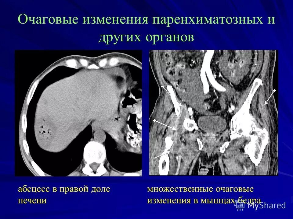 Очаг литической деструкции костной ткани. Очаг глиоза в лобной доле что это. Межфаланговые суставы (узелки гебердена, бушара);. Кортикальная атрофия головного мозга кт. Лакунарный глиоз.