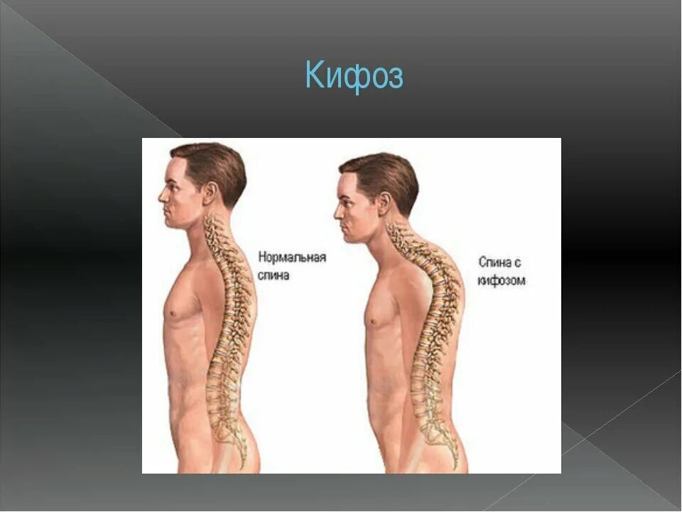 - Гиперкифоз (болезнь Шейермана-МАУ). Деформация позвоночника кифоз. Шармана МАУ болезнь позвоночника. Болезнь Шейермана МАУ 3 степени.