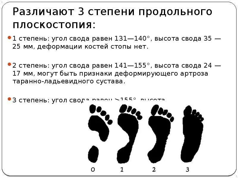 Плоскостопие с артрозом берут в армию. Степени плоскостопия 3 степени. Продольное плоскостопие третьей степени. Продольно-поперечное плоскостопие 2 степени. Двустороннее поперечное плоскостопие 3 степени.