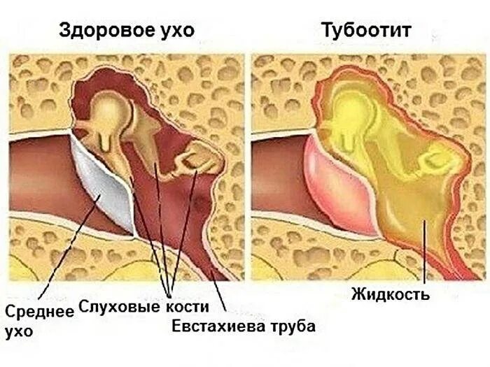 Хронический тубоотит