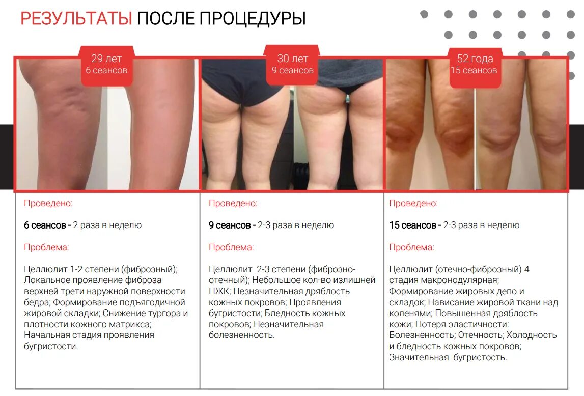 Рсл массаж. Рсл скульптурирование. рсл скульптурирование аппарат. rsl до после. рсл массаж до и после.