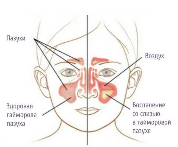 Схема пазух. Гайморит в гайморовой пазухе на схеме. гайморовы пазухи расположение схема. схема гайморовых пазух и носа. верхнечелюстная гайморова пазуха.