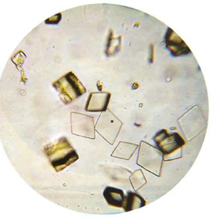 Фосфаты в какой моче. Микроскопия мочи Кристаллы мочевой кислоты. Соли мочевой кислоты микроскопия. Микроскопия осадка мочи трипельфосфаты. Трипельфосфаты мочевой кислоты в моче.