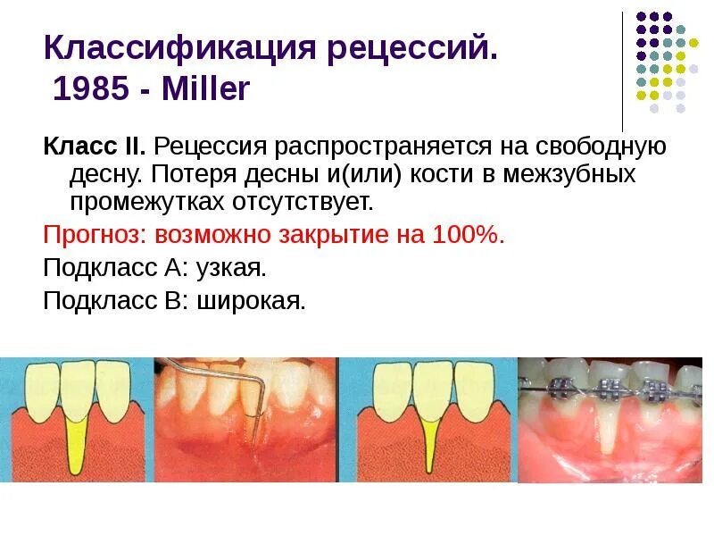 Рецессия десны по миллеру классы. Рецессия десны по миллеру классы. Рецессии десны iii класса по классификации миллера. Рецессия классификация миллера. Рецессия десны по миллеру классы.