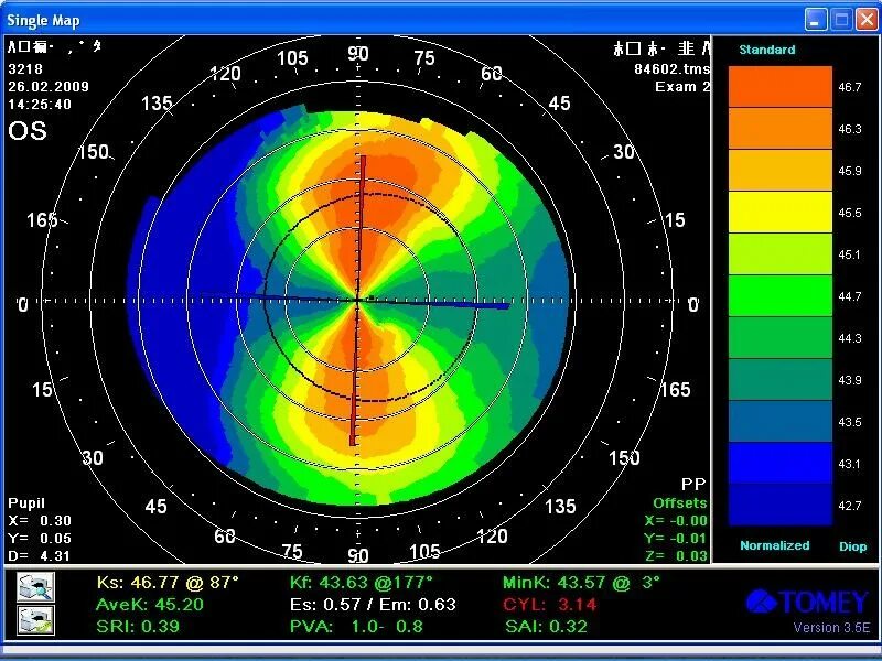 Астигматизм кератотопография. Топограмм. Кт топограмма головы и легких. Кератотопография роговицы расшифровка. Кератоконус кератотопограмма.