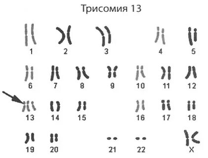 Кариотип 13
