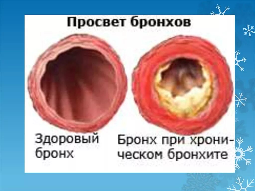 Бронхит заразен или. Острое воспаление слизистой оболочки бронхов. Просвет бронхов при бронхите. Воспаление слизистой оболочки бронхов.