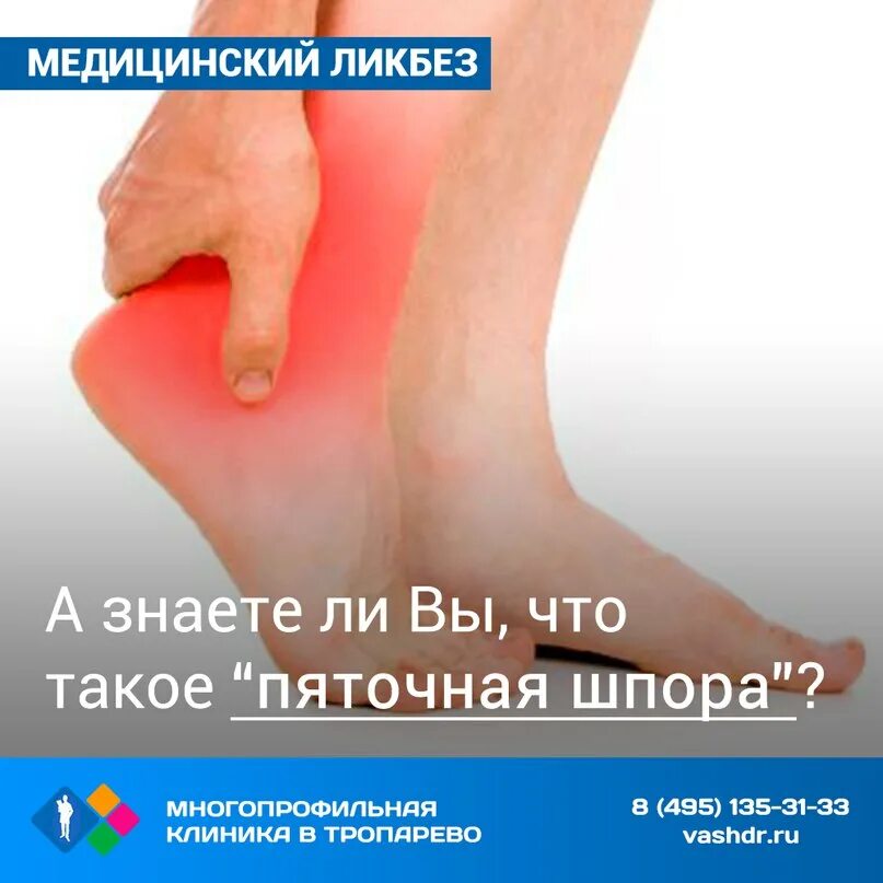 Пяточная шпора симптомы причины. Пяточная шпора плантарный фасциит. боль в пятке плантарный фасциит. плантарный фасциит клинические рекомендации. лекарства при подошвенном фасците.