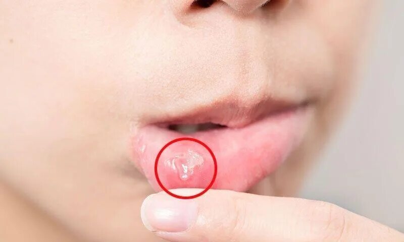 Actinic Cheilitis Skin Cancer And Reconstructive Surgery Center
