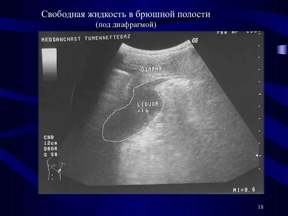 Свободная жидкость в малом тазу на узи. Жидкость на узи. Жидкость на узи. Расширение петель кишечника узи. Асцит на узи брюшной полости.