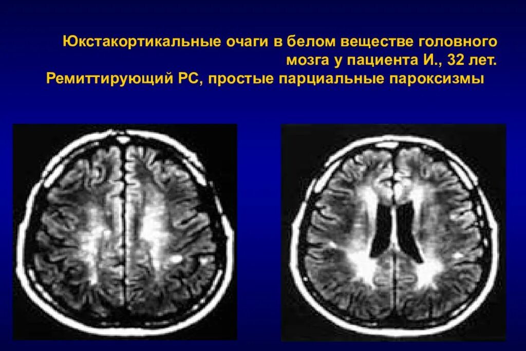 Инфратенториальные очаги головного мозга. Очаги в белом веществе головного мозга что это такое. Юкстакортикальные очаги головного мозга.