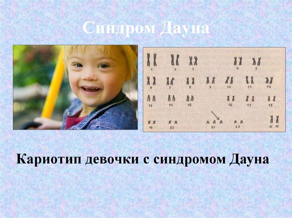Синдром дауна формула. Синдром дауна кариотип. кариотип девочки с синдромом дауна. кариотип человека с синдромом дауна. синдром дацеа картотип.