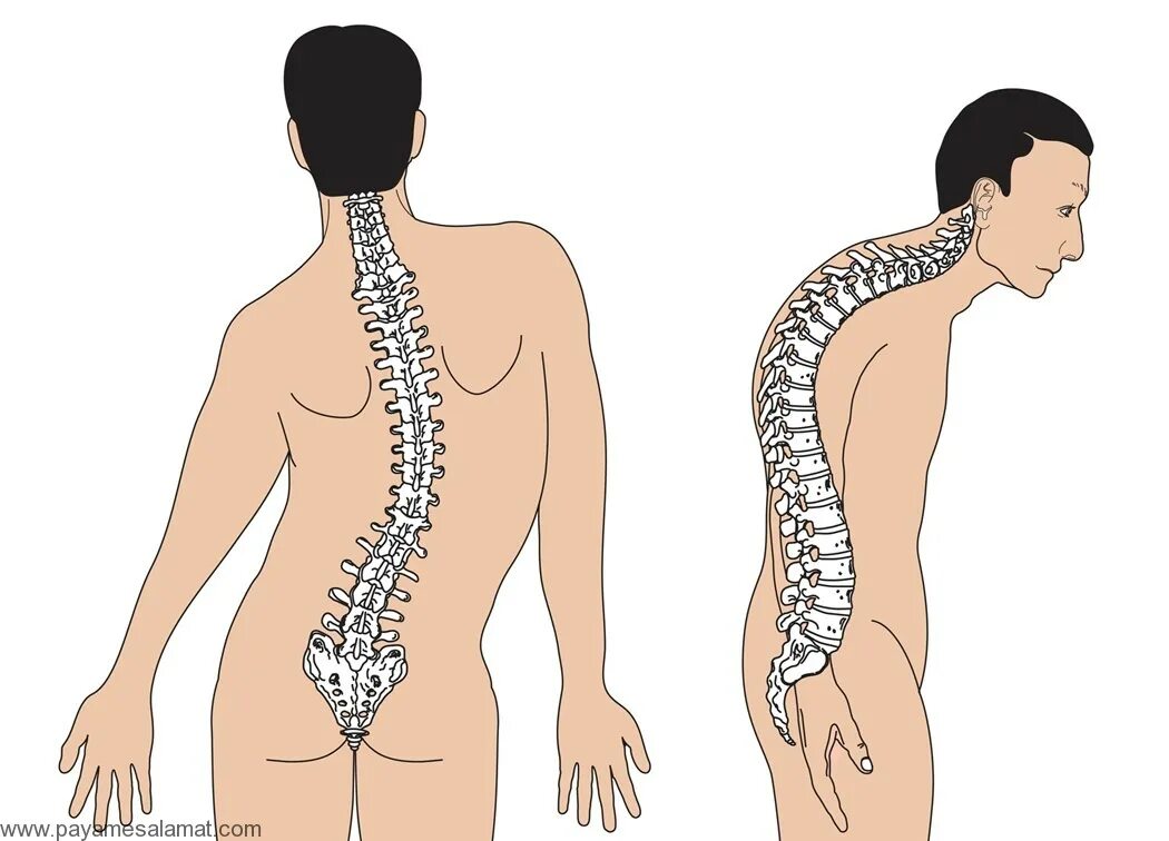 Лордоз позвоночника у детей. Кифоз + лордоз поясничного отдела позвоночника. Кифосколиоз лордоз грудного отдела позвоночника. 1 лордоз. Патологический лордоз.