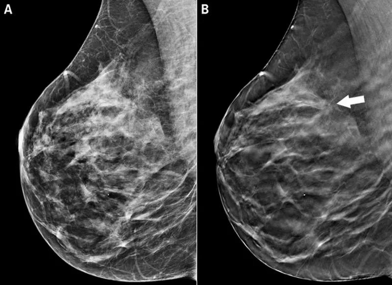 Маммография старый. Маммография рентген молочной железы. Мастопатия молочной железы маммограмма. Маммография рентгеновские снимки. Норма молочной железы на маммографии.