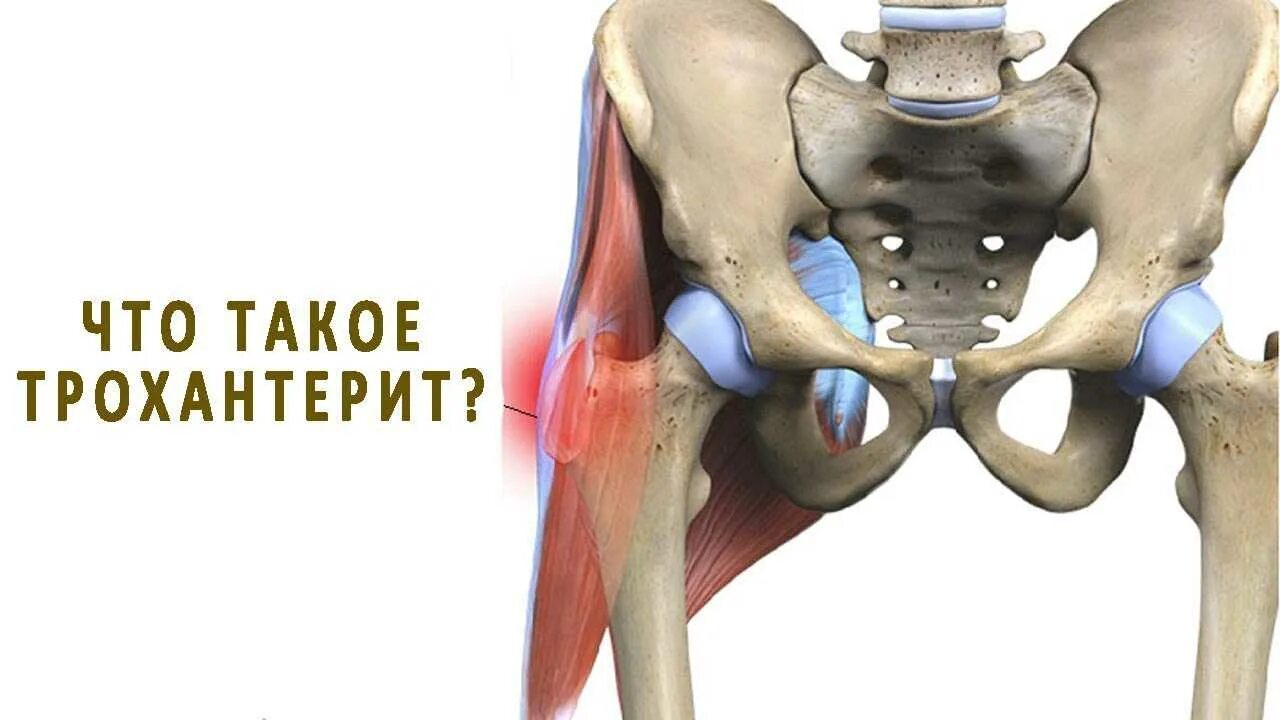 Тазобедренный сустав лечение врач. Блокада трохантерита тазобедренного сустава. Трохантерит тазобедренного сустава . Сухожилия. Воспаление бедренных сухожилий — трохантерит.
