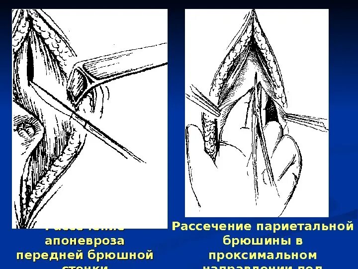 Рассечение термин. Техника рассечения париетальной брюшины. рассечение передней брюшной стенки.
