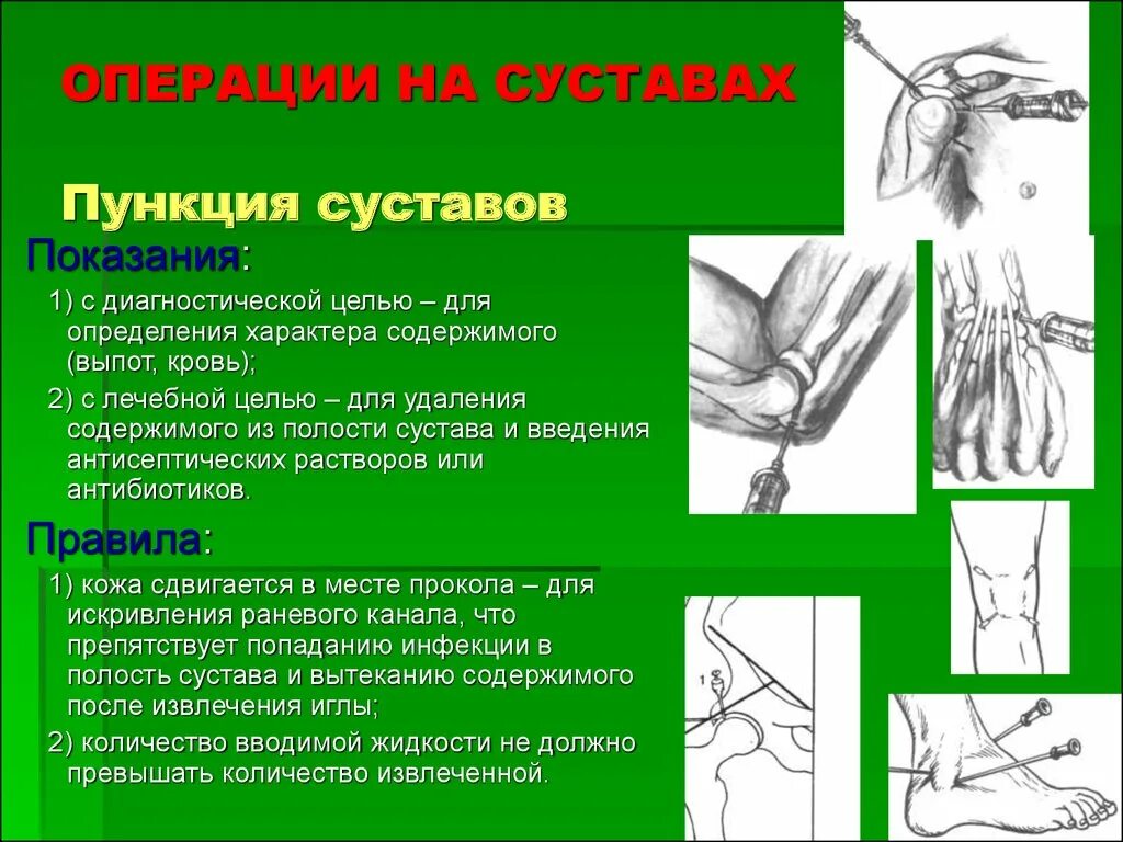Пункция сустава техника выполнения