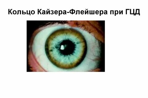 Кольца кайзера