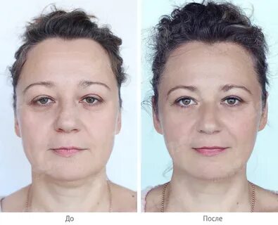 Лечение птоза верхнего века операция