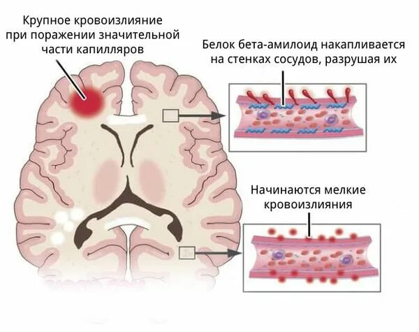 Микроангиопатия головного мозга fazekas. Микроангиопатии головного мозга что это такое. Очаги микроангиопатии головного мозга что это такое. Церебральный ангиоспазм. Церебральная микроангиопатия кт.