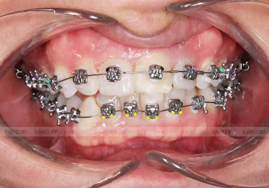 Система н4. Брекеты pitts21 самолигирующие. Брекеты h4 самолигирующие металлические. Брекеты ортолайт h4. Система н4.