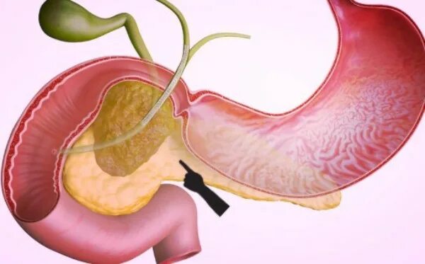 Панкреатит и язва желудка. Хронический билиарнозависимый панкреатит. Острый билиарный панкреатит. Билиарнозависимый панкреатит панкреатит. Небидиарный панкреатит.