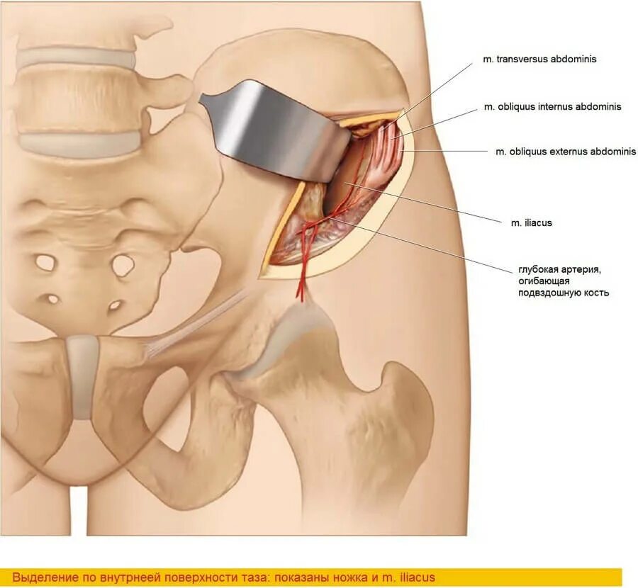 Боль в подвздошной кости. Лоскут гребня подвздошной кости. Трепанобиопсия подвздошной кости. Гребень крыла подвздошной кости. Подвздошный гребень анатомия.