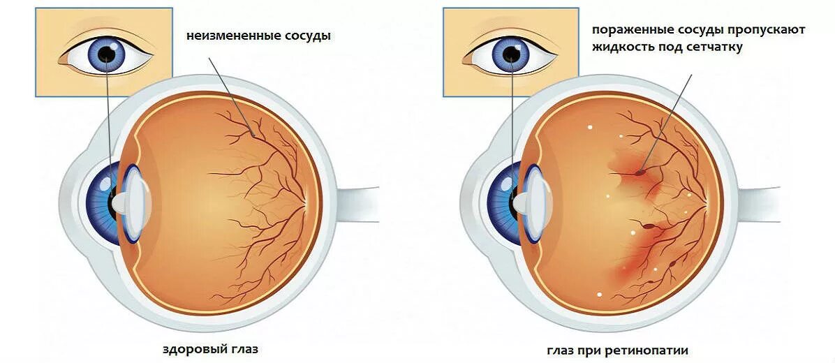 Сетчатку меняют